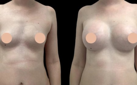 Precision & Passion: The Best Breast Augmentation Surgeon in Dubai