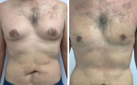 The Advantages of Gynecomastia Surgery in Dubai