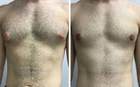 Real Patient Testimonials About the Best Gynecomastia Surgeons in Dubai