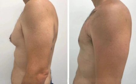 Gynecomastia in Dubai: A Step-by-Step Guide from the Best Surgeons