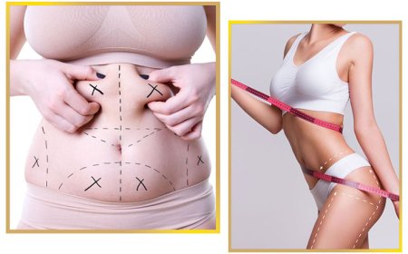 Everything You Need to Know About Liposuction in Islamabad