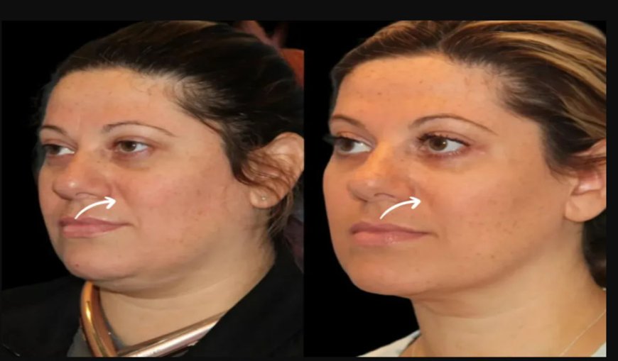 Best Aesthetic Clinics in Dubai for Sculptra Fillers for Mature Skin