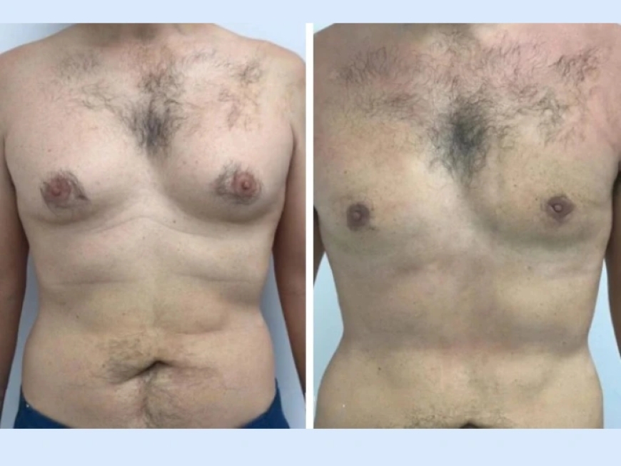 The Advantages of Gynecomastia Surgery in Dubai