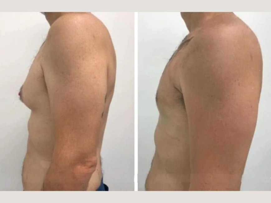 Gynecomastia in Dubai: A Step-by-Step Guide from the Best Surgeons