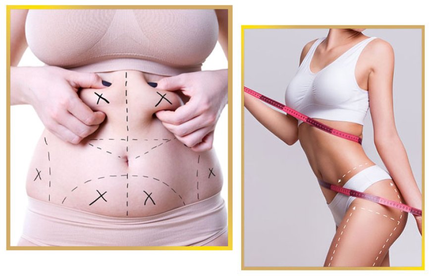 Everything You Need to Know About Liposuction in Islamabad