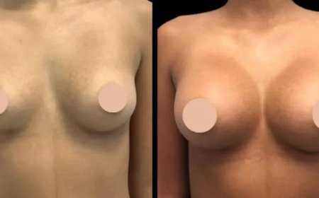 Breast Augmentation Surgery in Dubai: The Benefits of Choosing Dubai for Your Cosmetic Procedure