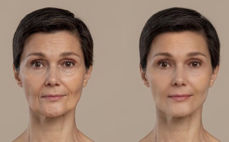 How Many Treatments Are Needed for Noticeable Results Under the Eyes?