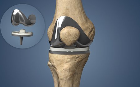 How Safe Is Knee Replacement Surgery for Diabetic or Heart Patients?