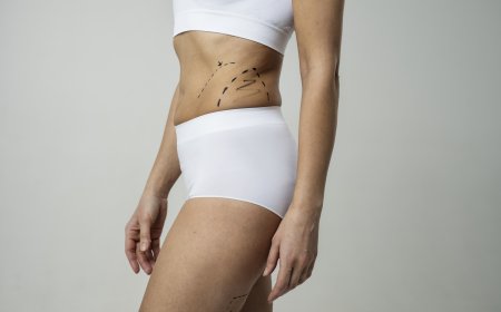 Truth About Liposuction Guidance from Best Liposuction Surgeon in Dubai