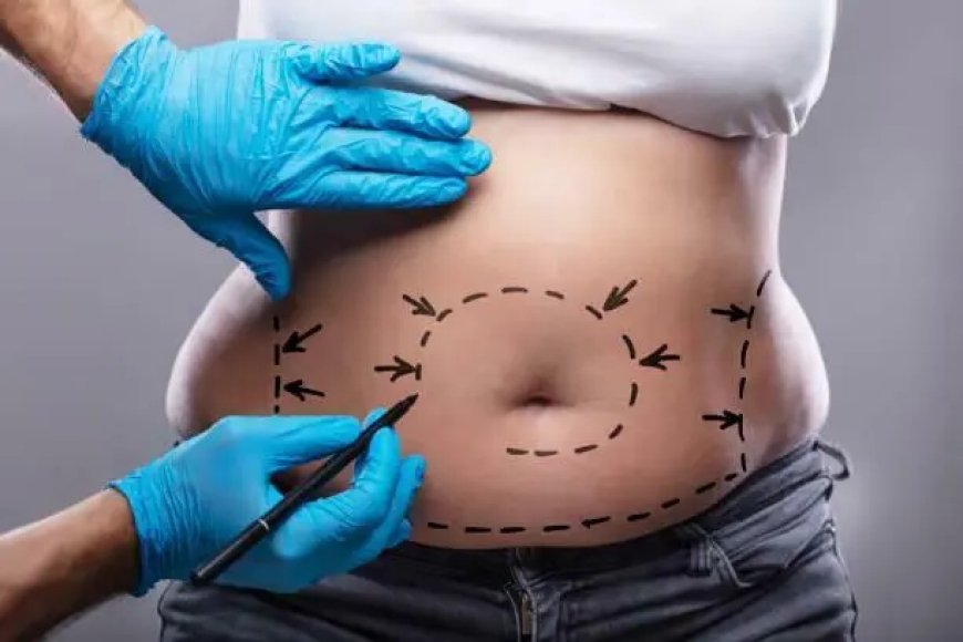 A Complete Beginner’s Guide to Liposuction Islamabad